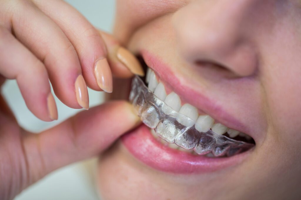 Woman placing a clear Invisalign aligner over her teeth