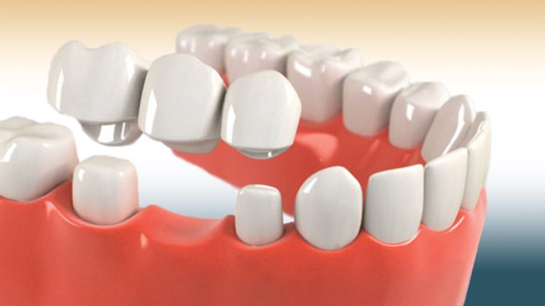 Dental Bridges Explained: Types, Cost & Lifespan
