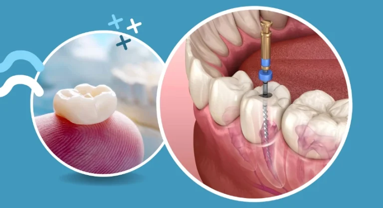 Root Canal Toronto