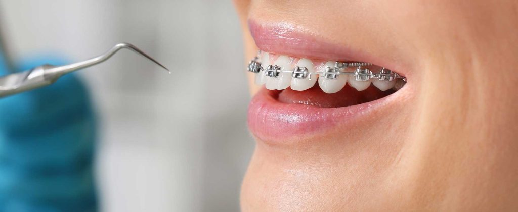 Close-up of metal dental braces being checked by a dentist on Danforth