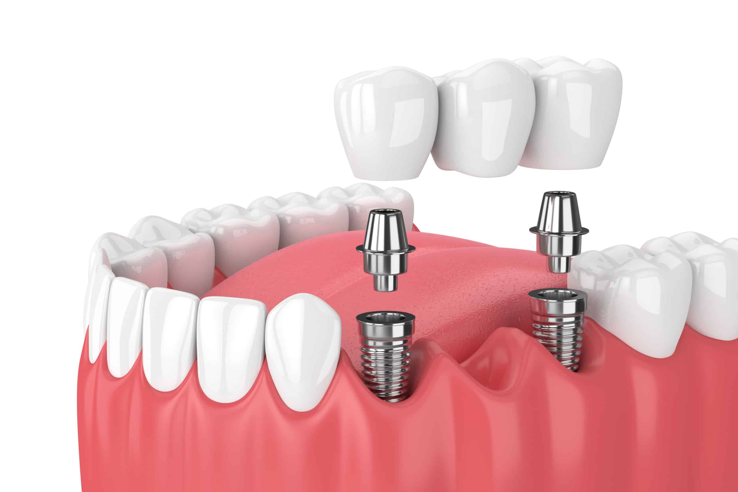 3D illustration of an implant-supported dental bridge replacing missing teeth