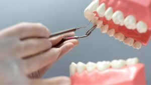 Dental Crowns
