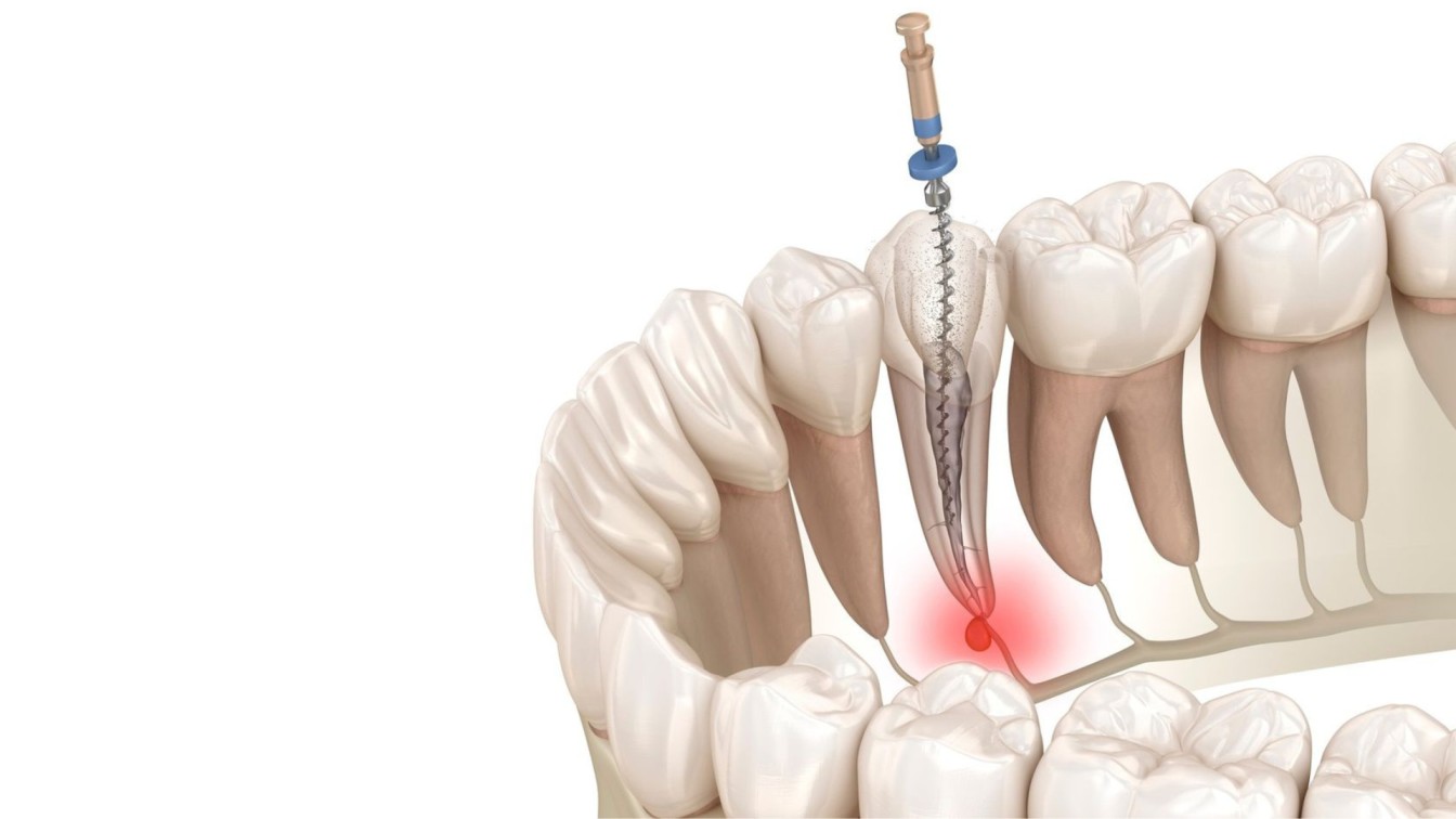 Root Canal Treatment