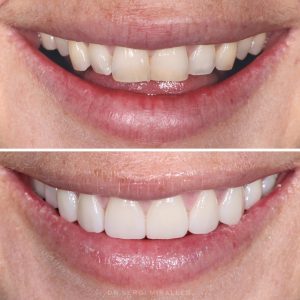 Before and after smile makeover showing straighter, whiter teeth