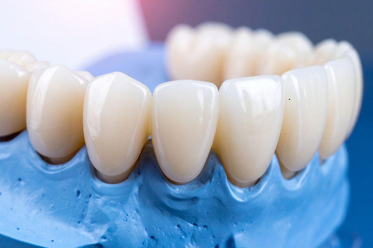 Porcelain dental bridge on a dental model
