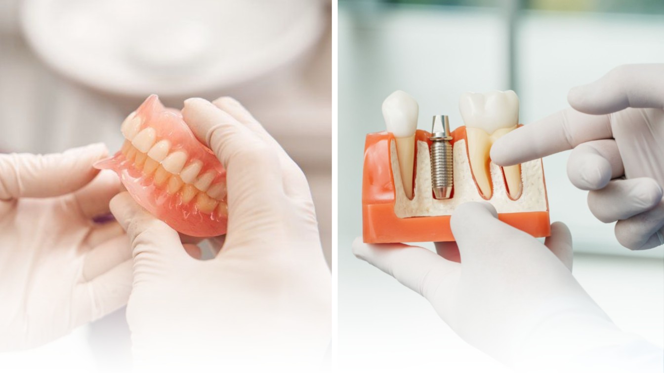 Comparison of dentures versus dental implants for replacing missing teeth