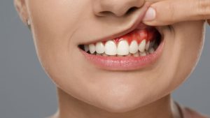 Gum disease