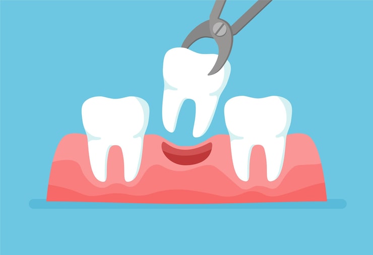 Illustration of a tooth being removed during a simple tooth extraction